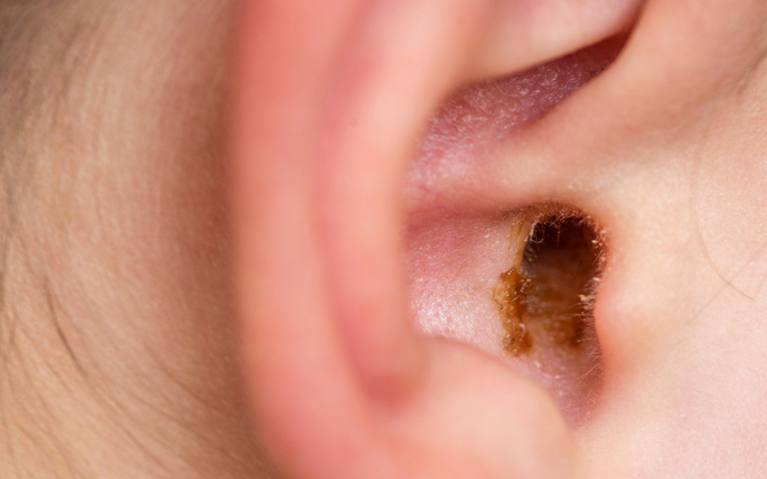 Kulak Kiri (Serumen) Nedir? Nasıl Oluşur?